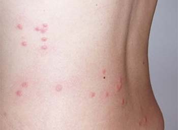 flea bites on human back